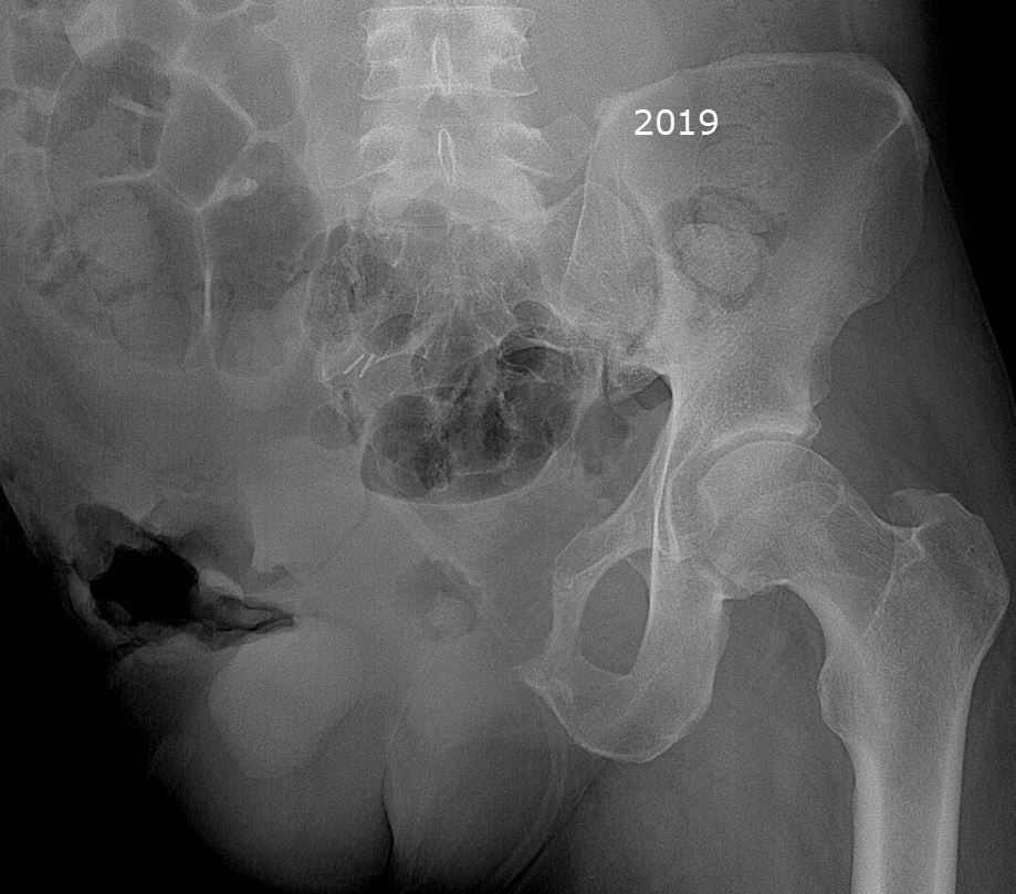 Figure 5 for case Primary angiosarcoma of bone